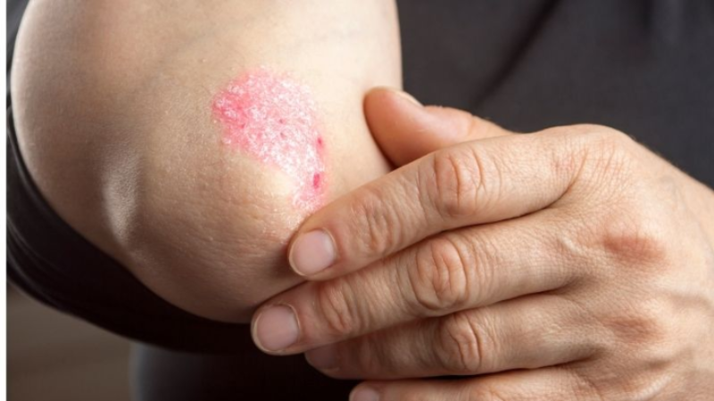 A Complete Guide on Everything About Psoriasis, Its Causes, Triggers, Symptoms and Types
